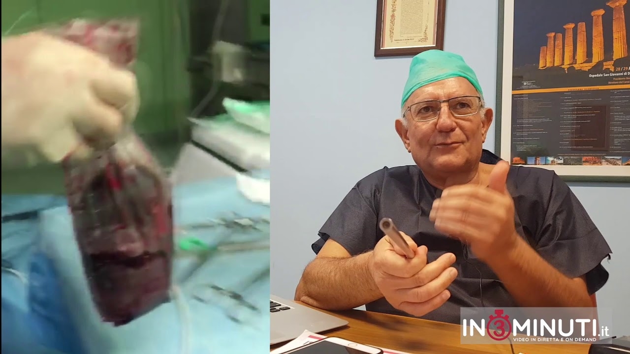 Innovativo intervento di asportazione laparoscopica della milza ad Agrigento, Carmelo Sciumè 📹VIDEO